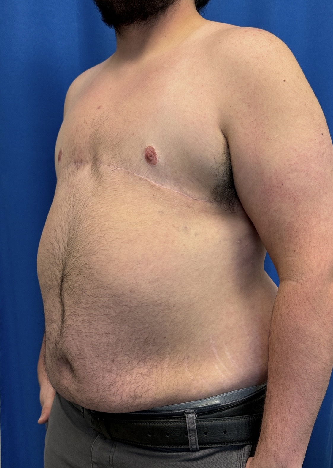 FTM top surgery (mastectomy) result 2