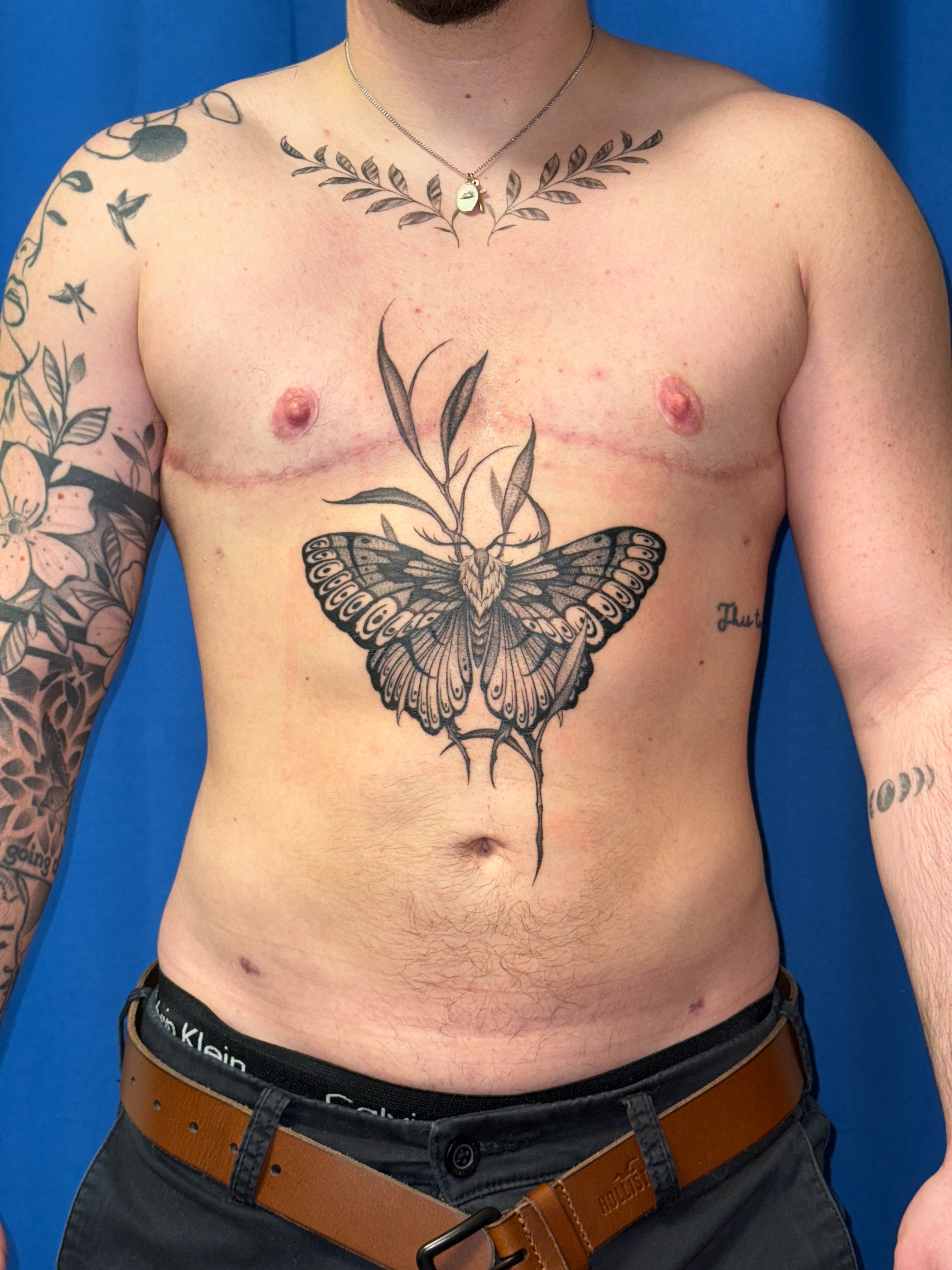 FTM top surgery (mastectomy) result 14