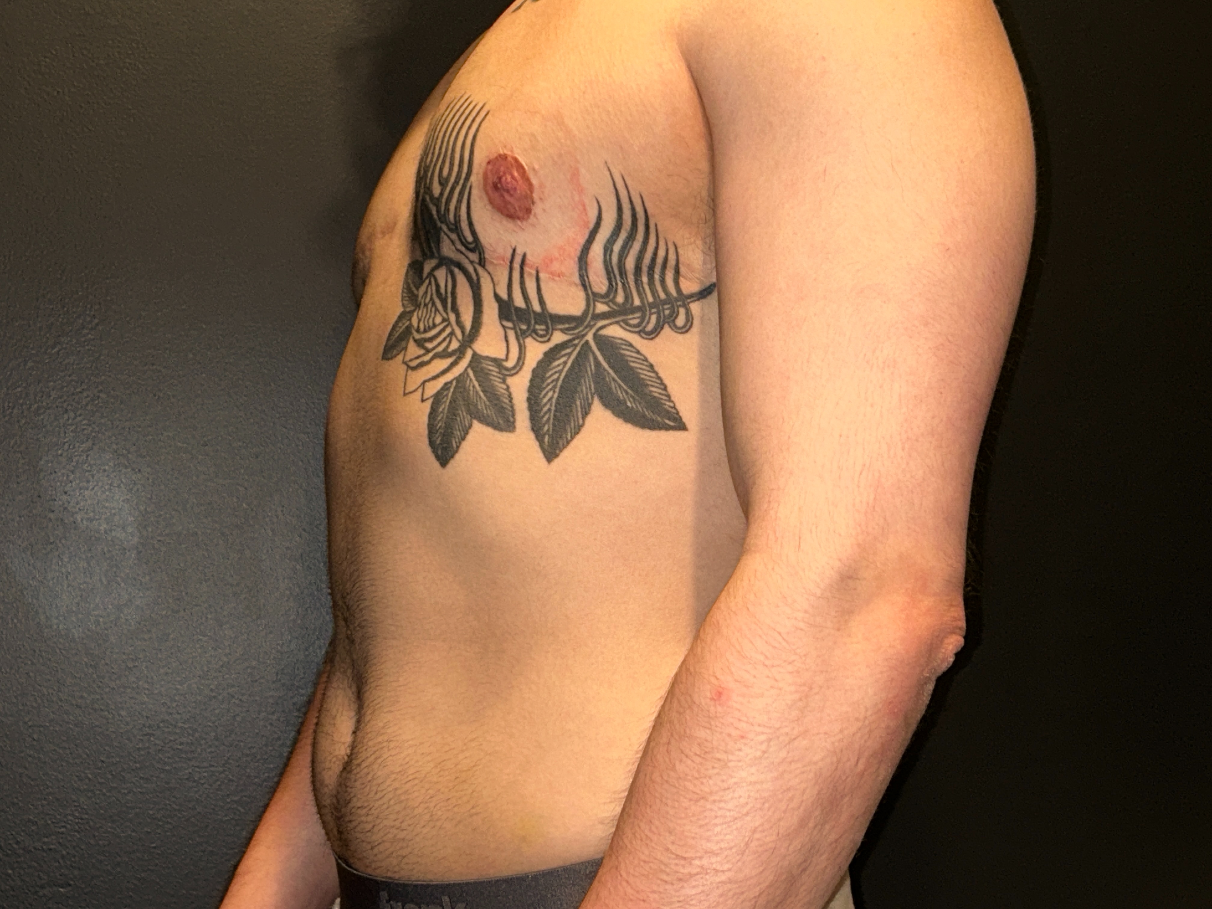 FTM top surgery (mastectomy) result 8