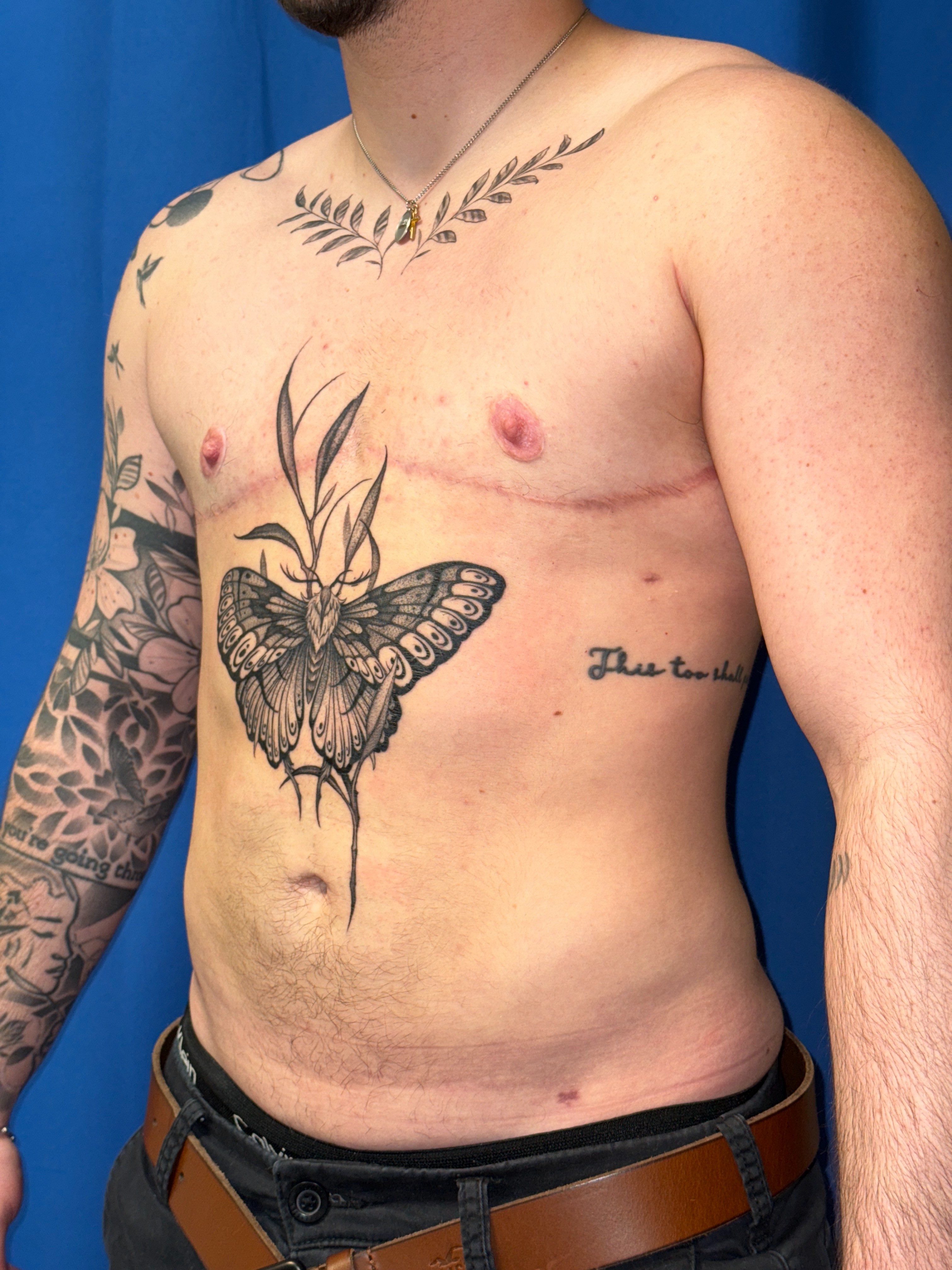 FTM top surgery (mastectomy) result 15