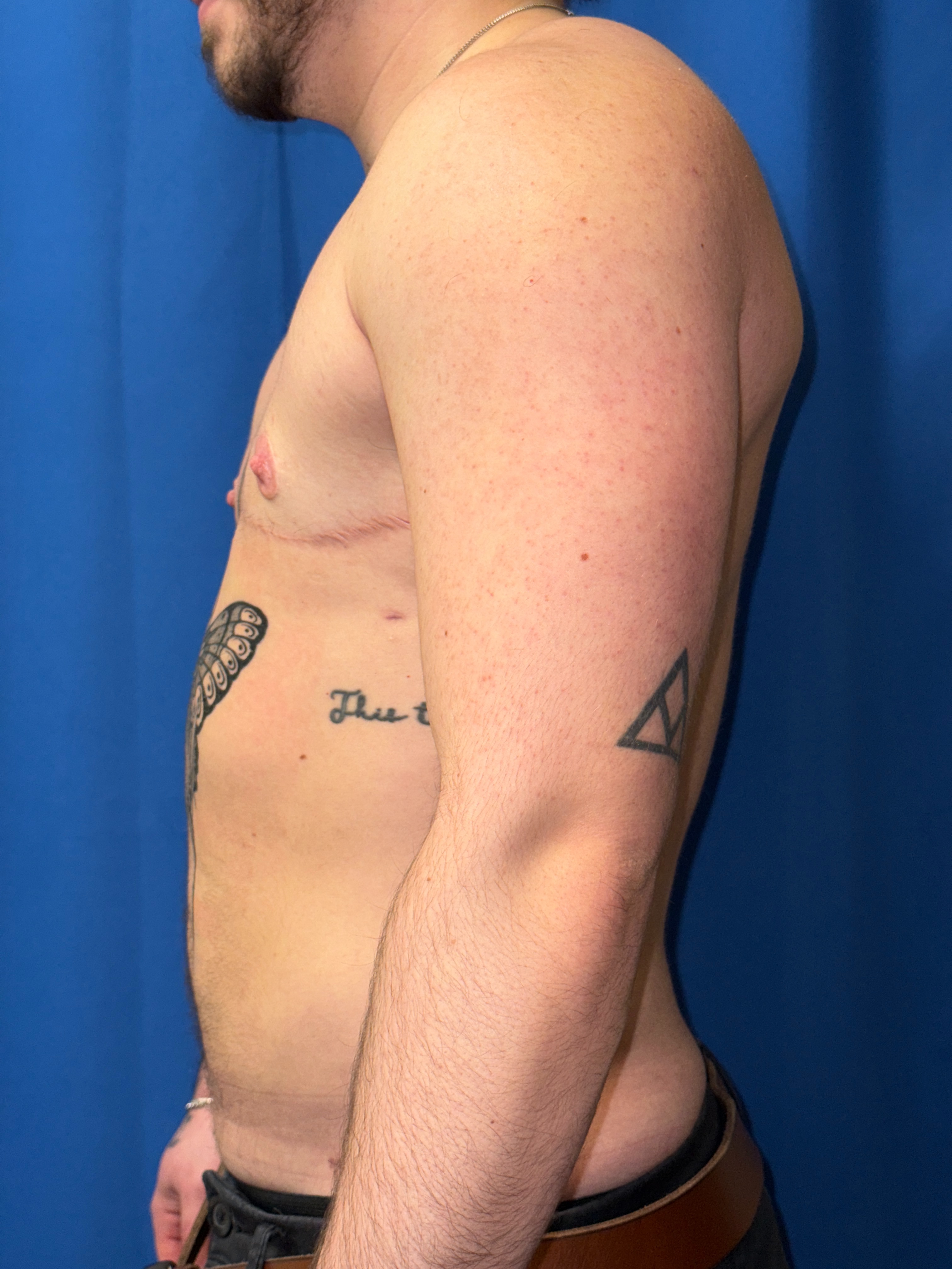 FTM top surgery (mastectomy) result 17