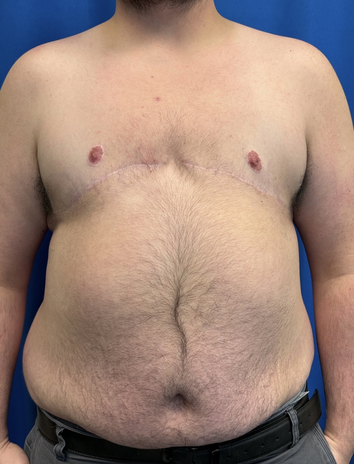 FTM top surgery (mastectomy) result 1