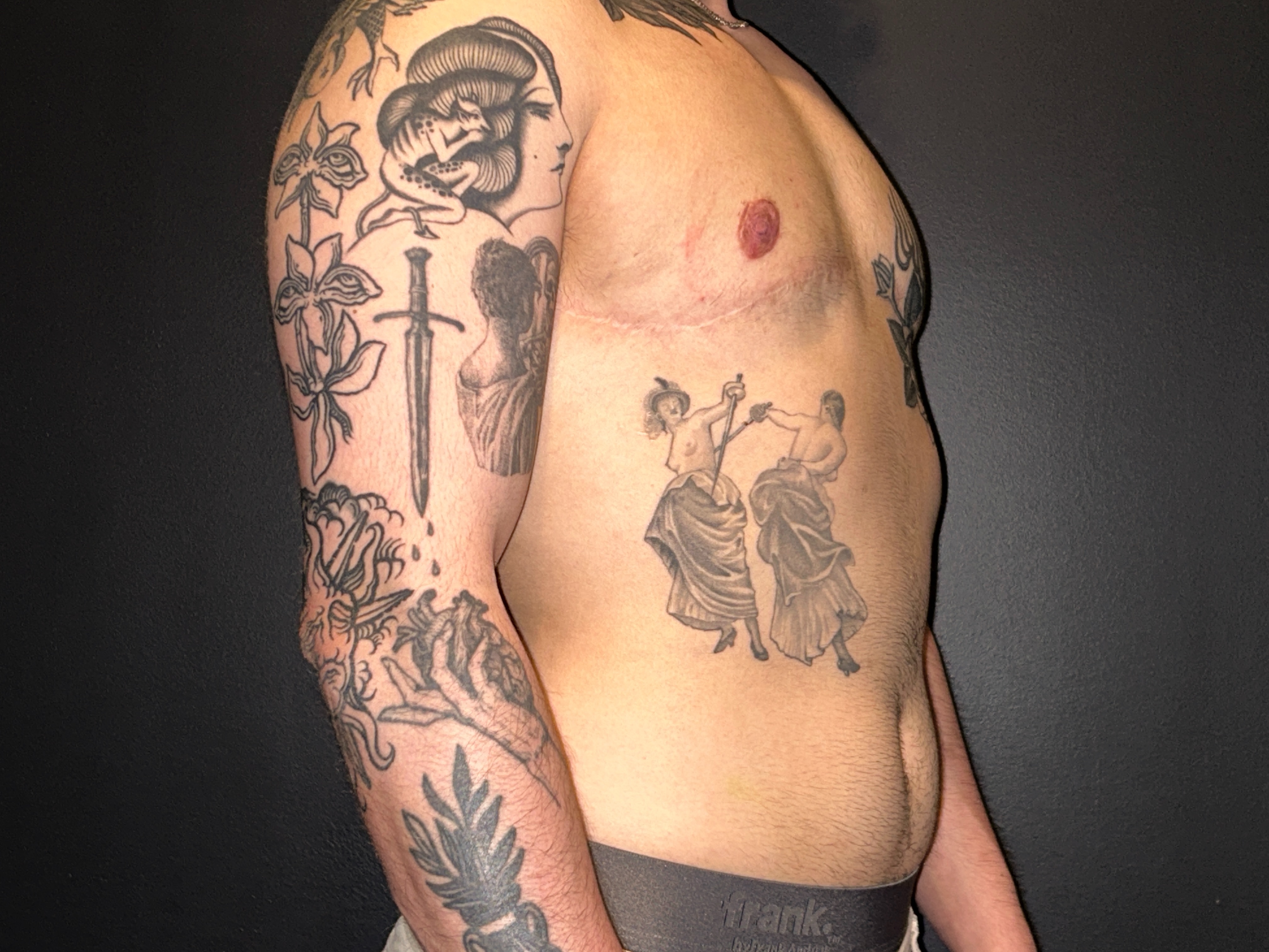 FTM top surgery (mastectomy) result 7