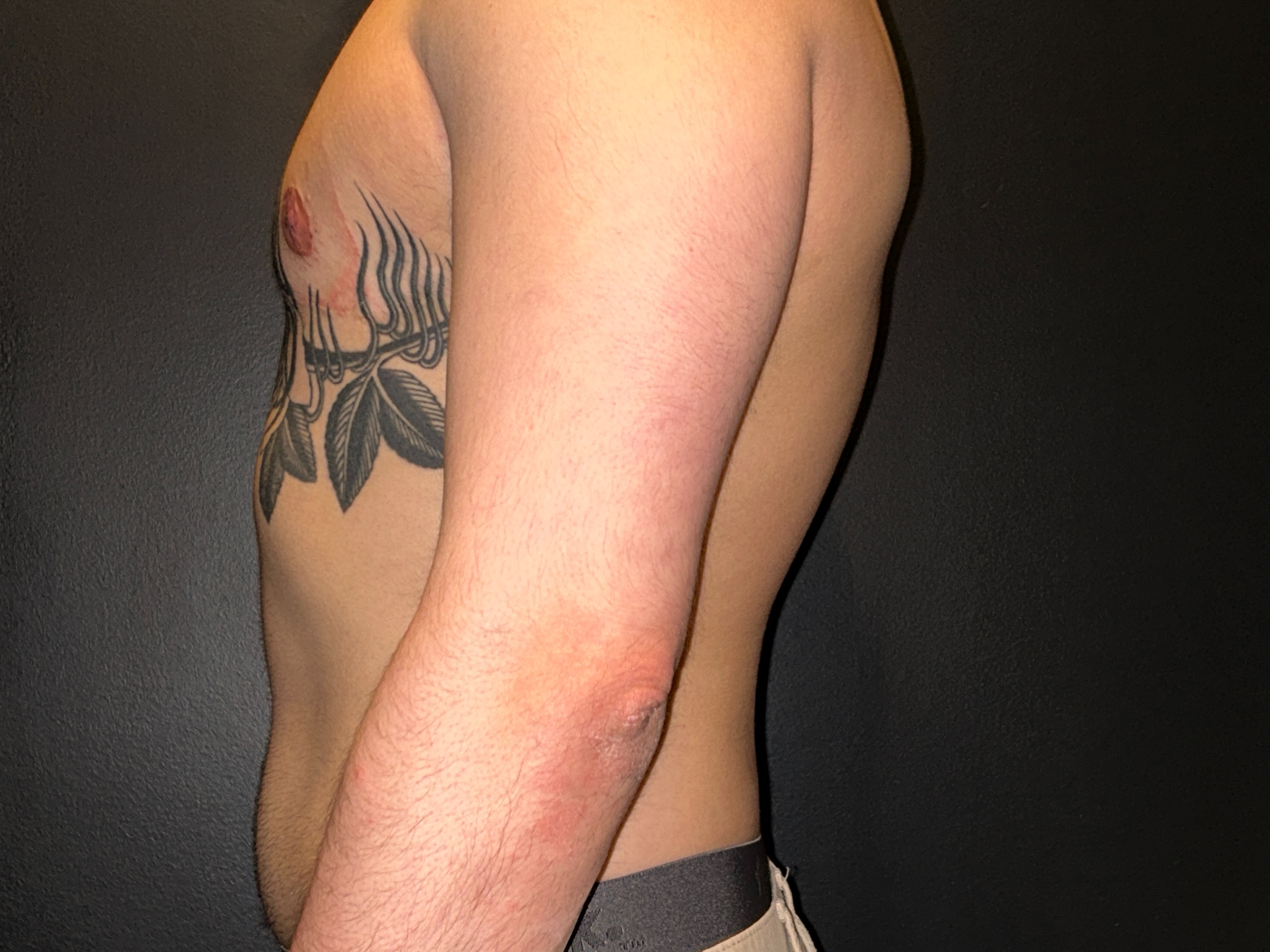 FTM top surgery (mastectomy) result 10